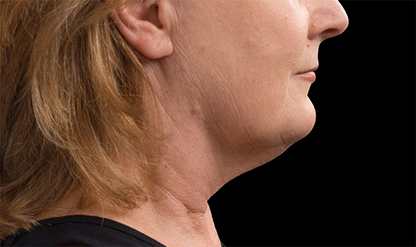 double chin reduction treatment coolsculpting soho nyc manhattan